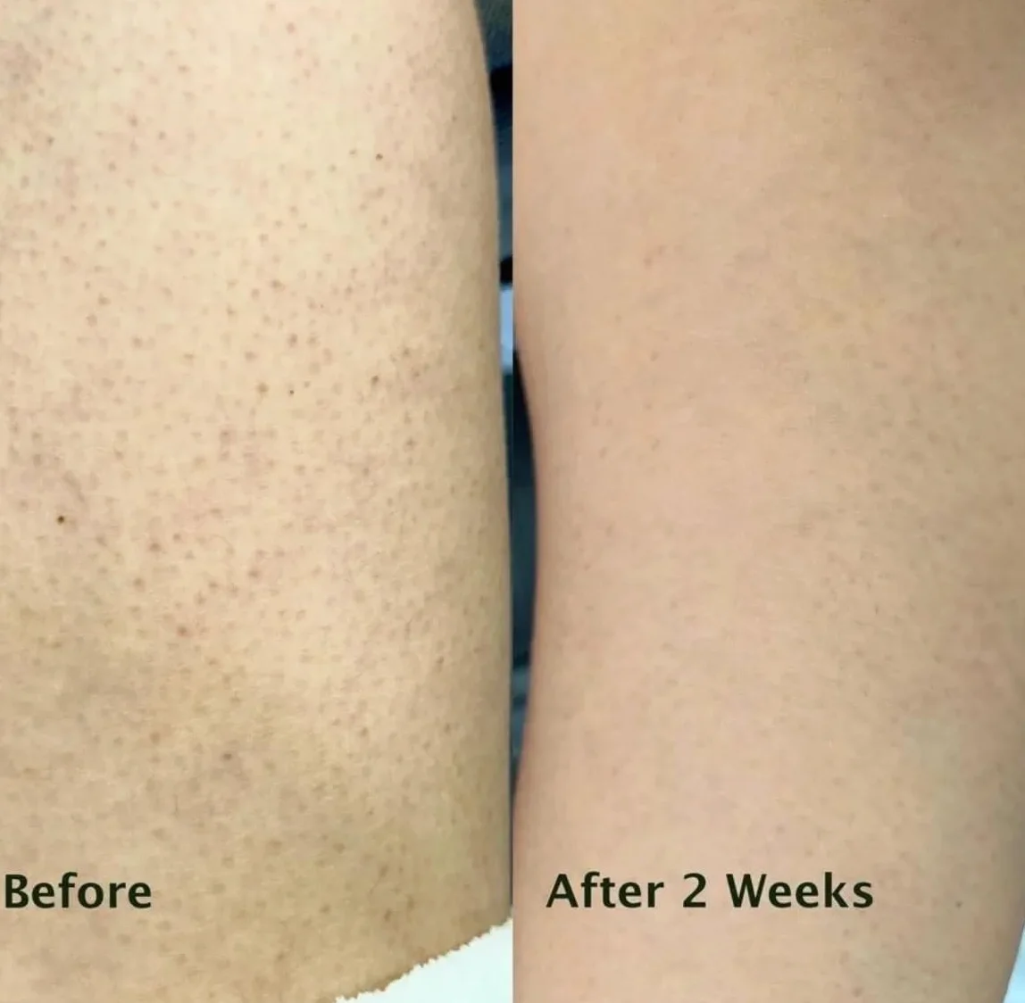 Spray na Keratosis Pilaris – usuwa rogowacenie mieszkowe, gęsią skórkę i szorstką skórę z kwasem salicylowym, glikolowym, pantenolem i gliceryną