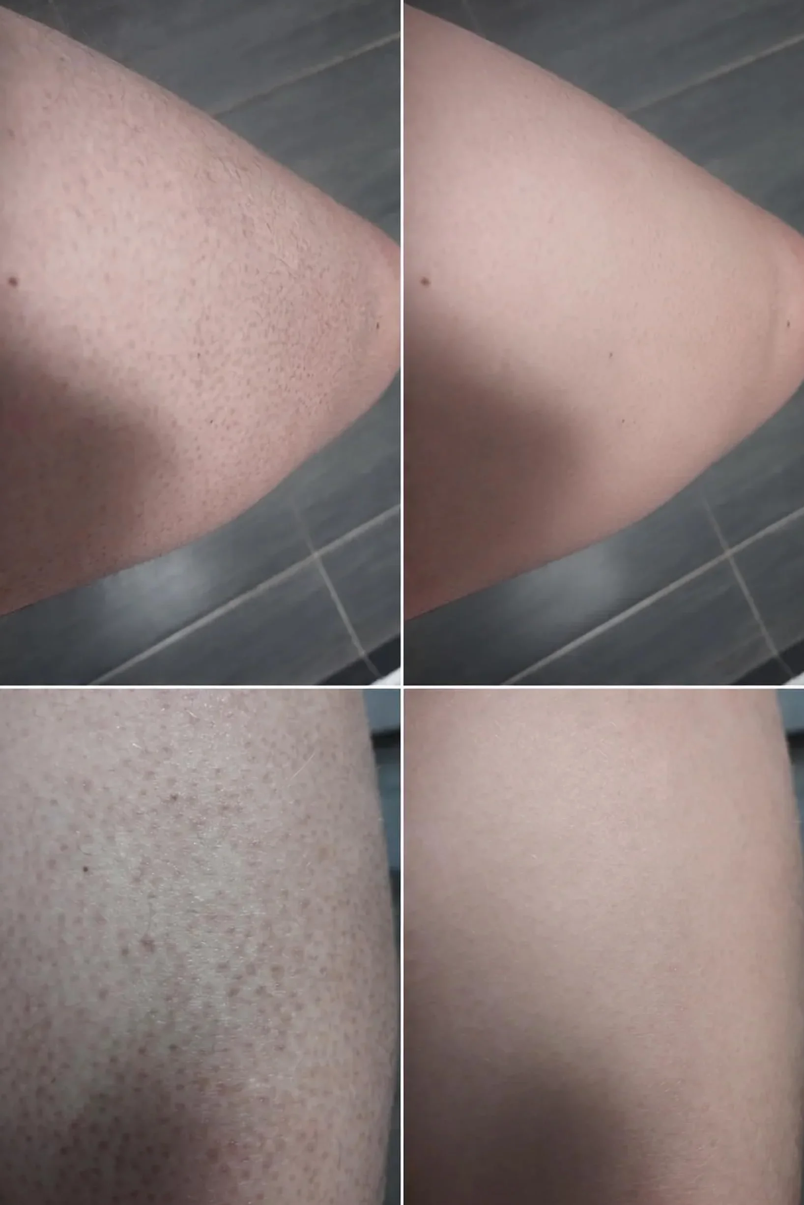 Spray na Keratosis Pilaris – usuwa rogowacenie mieszkowe, gęsią skórkę i szorstką skórę z kwasem salicylowym, glikolowym, pantenolem i gliceryną